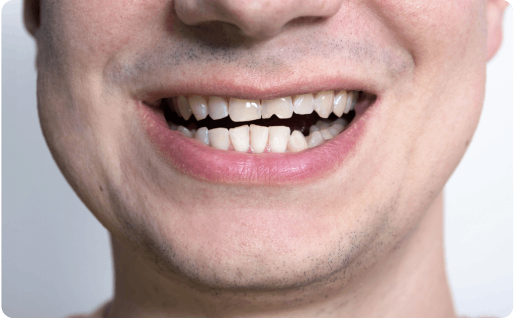 Broken tooth